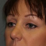 Eye Lid Lift Before & After Patient #676