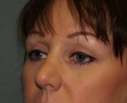 Eye Lid Lift Before & After Patient #676