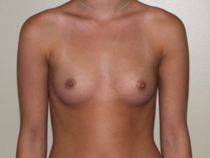 Breast Augmentation Before & After Patient #2489
