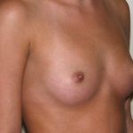 Breast Augmentation Before & After Patient #2489