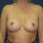 Breast Augmentation Before & After Patient #2948