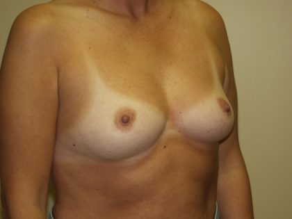Breast Augmentation Before & After Patient #2948