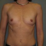 Breast Augmentation Before & After Patient #2573