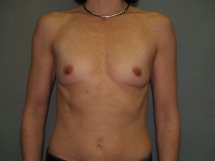 Breast Augmentation Before & After Patient #2573