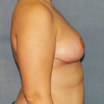 Breast Reduction Before & After Patient #3458