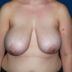 Breast Reduction Before & After Patient #3458