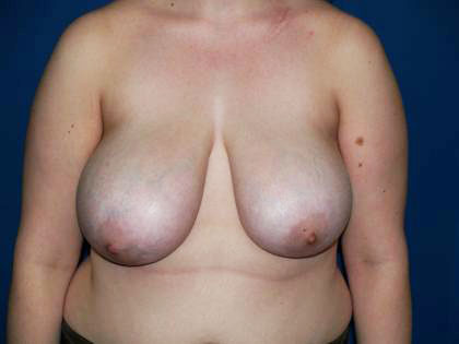 Breast Reduction Before & After Patient #3458