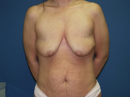 Breast Lift with Implant Before & After Patient #1551