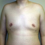 Gynecomastia Before & After Patient #941