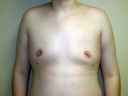 Gynecomastia Before & After Patient #941