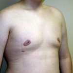 Gynecomastia Before & After Patient #941