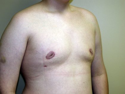 Gynecomastia Before & After Patient #941