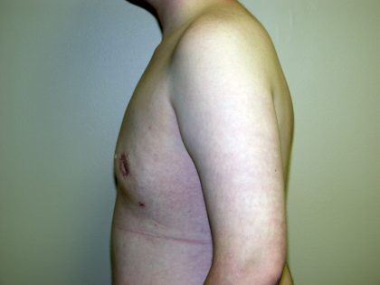 Gynecomastia Before & After Patient #941