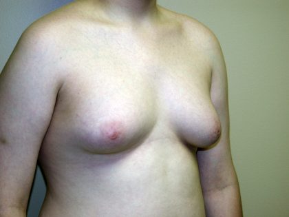 Gynecomastia Before & After Patient #941