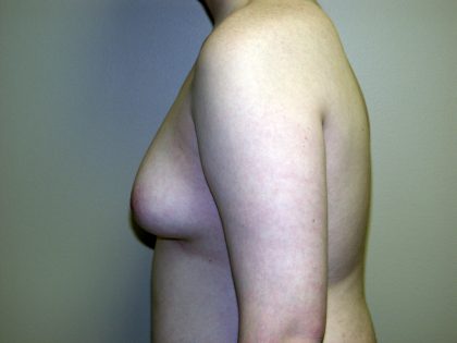 Gynecomastia Before & After Patient #941