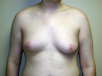 Gynecomastia Before & After Patient #941