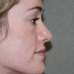 Nose Surgery Before & After Patient #788
