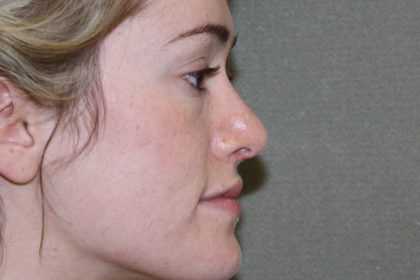 Nose Surgery Before & After Patient #788