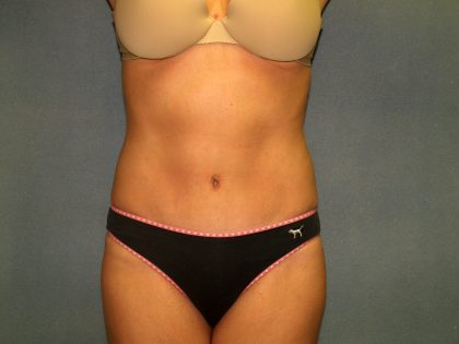 Tummy Tuck Before & After Patient #2074