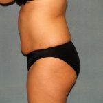 Tummy Tuck Before & After Patient #2074