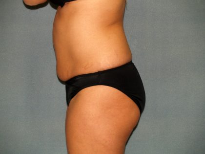 Tummy Tuck Before & After Patient #2074