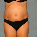 Tummy Tuck Before & After Patient #2074