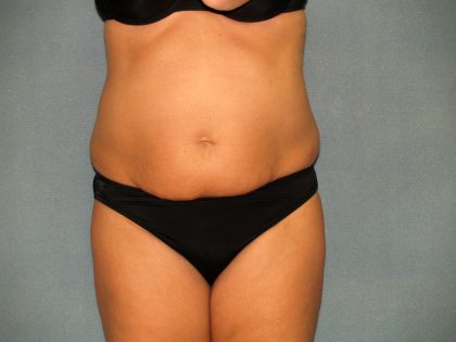 Tummy Tuck Before & After Patient #2074