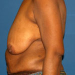 Breast Reduction Before & After Patient #3255