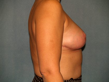 Breast Reduction Before & After Patient #3175