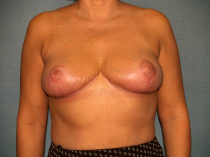 Breast Reduction Before & After Patient #3175