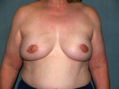 Breast Reconstruction Before & After Patient #1753