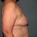 Breast Reconstruction Before & After Patient #1753