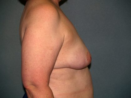 Breast Reconstruction Before & After Patient #1753