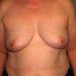 Breast Reconstruction Before & After Patient #1753