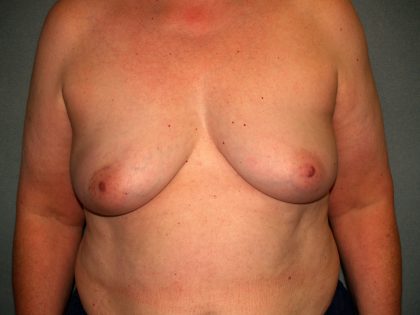 Breast Reconstruction Before & After Patient #1753