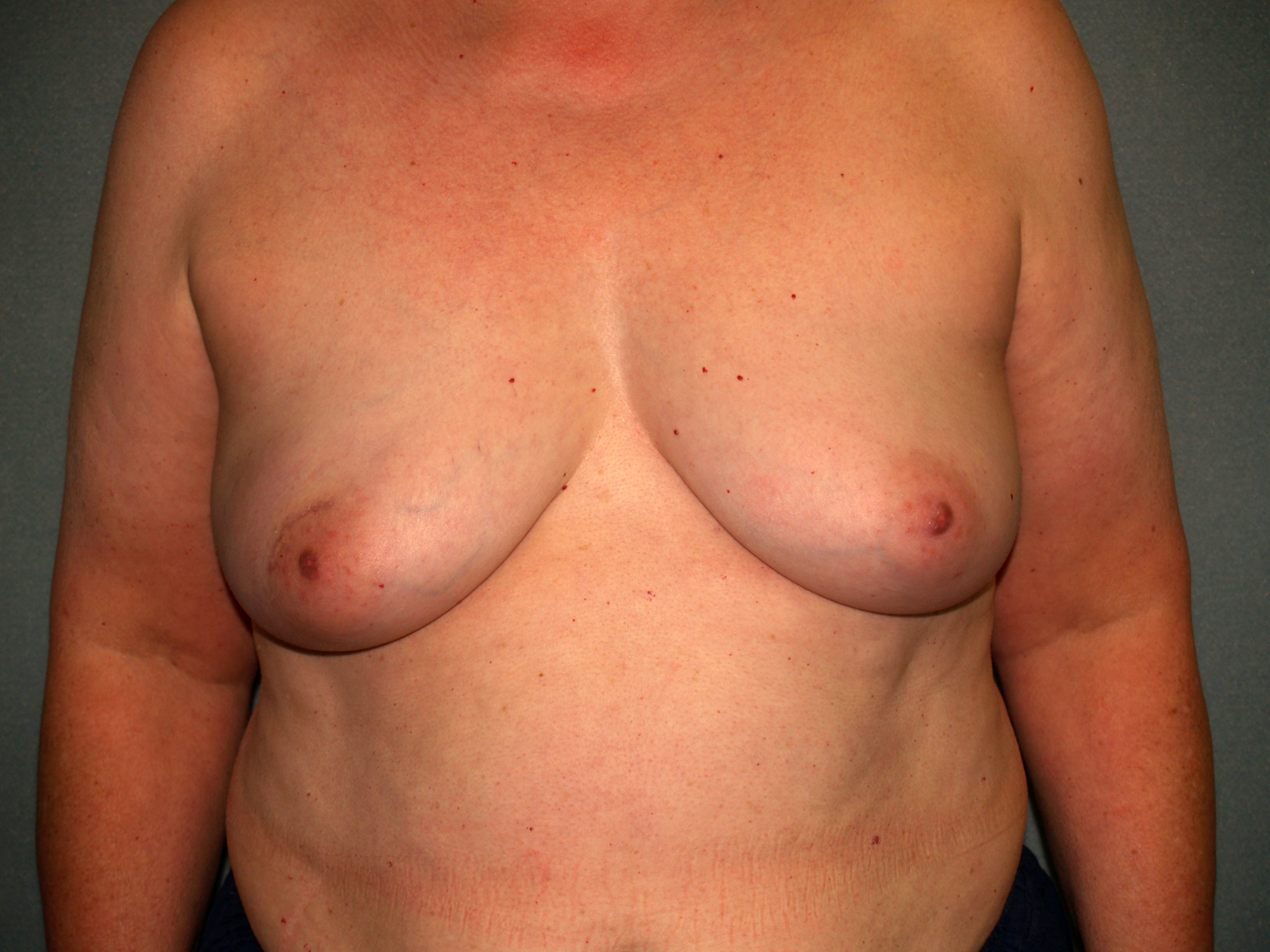 Breast Reconstruction Before & After Patient #1753