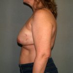 Breast Reconstruction Before & After Patient #2061