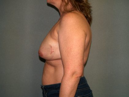 Breast Reconstruction Before & After Patient #2061