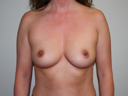 Breast Augmentation Before & After Patient #2454