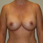 Breast Augmentation Before & After Patient #2454