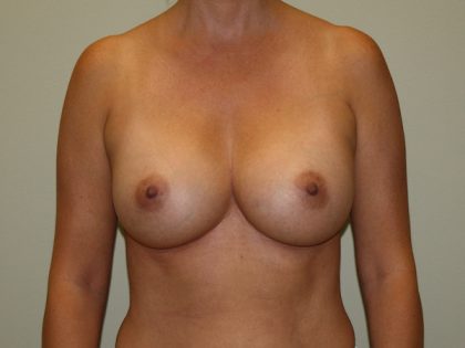 Breast Augmentation Before & After Patient #2454