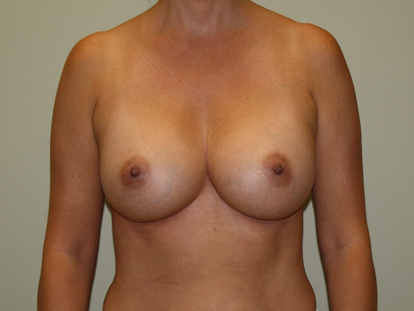Breast Augmentation Before & After Patient #2454
