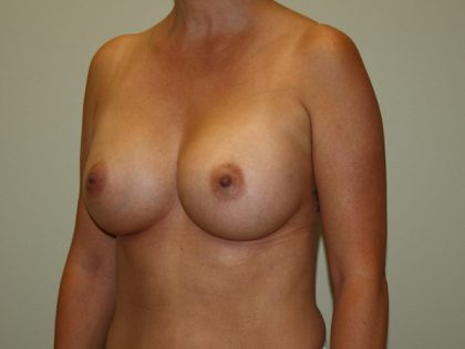 Breast Augmentation Before & After Patient #2454