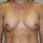 Breast Augmentation Before & After Patient #2461