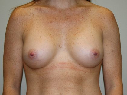 Breast Augmentation Before & After Patient #2461