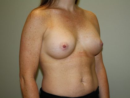 Breast Augmentation Before & After Patient #2461