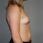 Breast Augmentation Before & After Patient #2461