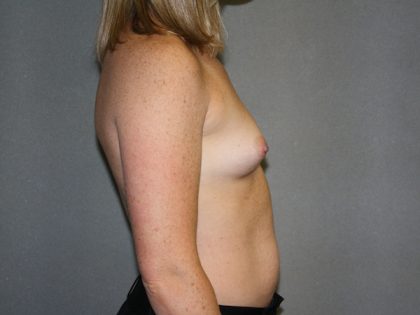 Breast Augmentation Before & After Patient #2461