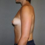 Breast Augmentation Before & After Patient #2496