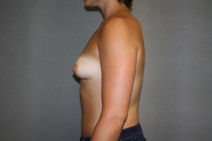 Breast Augmentation Before & After Patient #2496